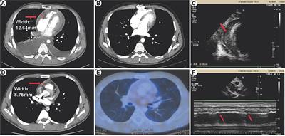 Analysis of the clinical manifestations and diagnostic process of the pleural effusion associated with constrictive pericarditis